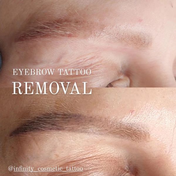 COSMETIC TATTOO REMOVAL Infinity Cosmetic Tattoo